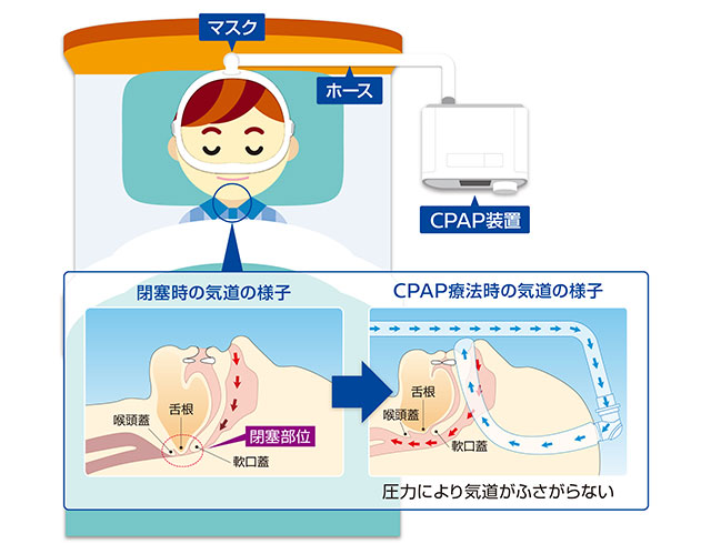 CPAP